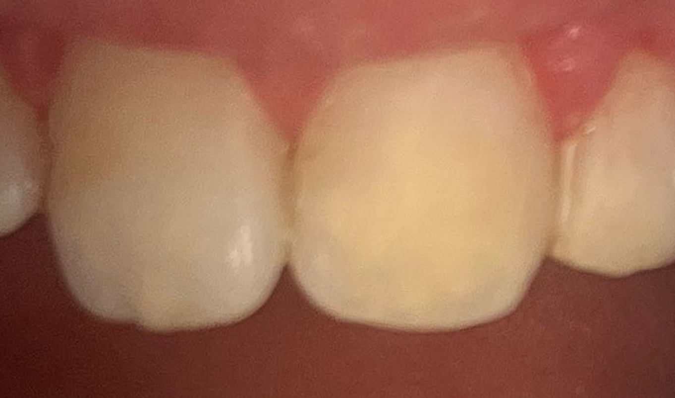 teeth-whitening-1-after teeth-whitening-1-after