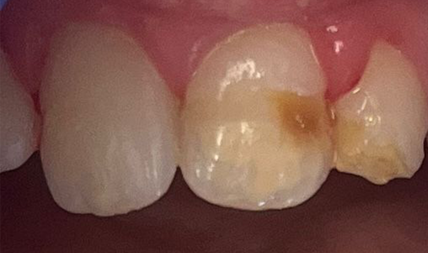 teeth-whitening-1-before teeth-whitening-1-before