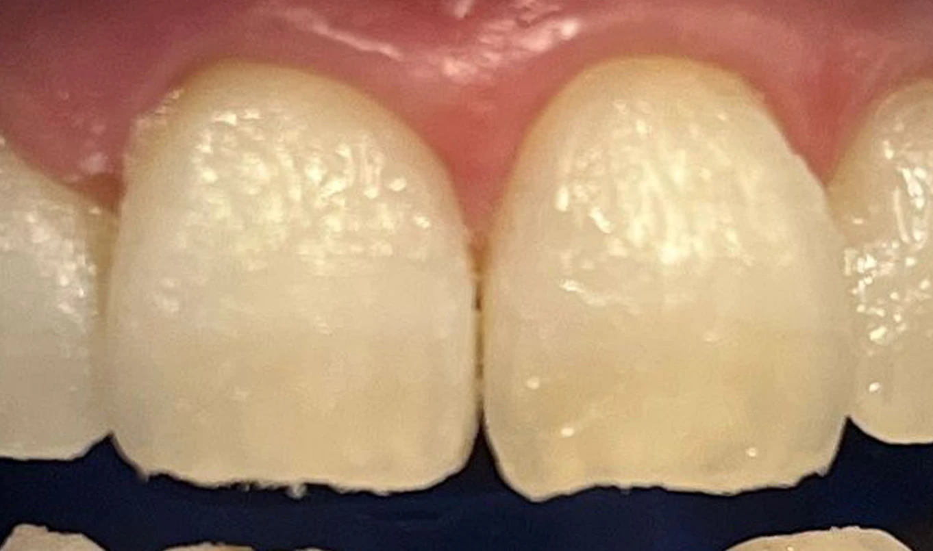 teeth-whitening-2-after2 (1) teeth-whitening-2-after2 (1)