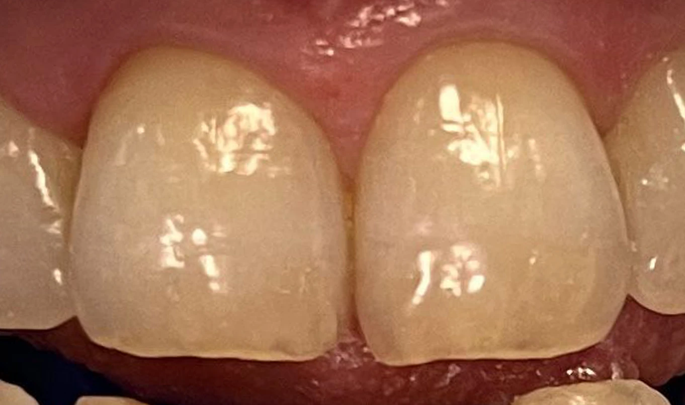 teeth-whitening-2-before1 (1) teeth-whitening-2-before1 (1)