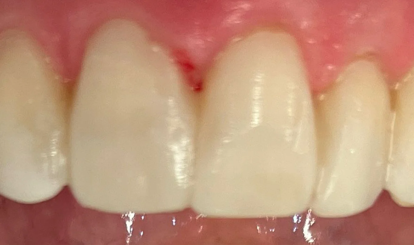 teeth-whitening-3-after teeth-whitening-3-after