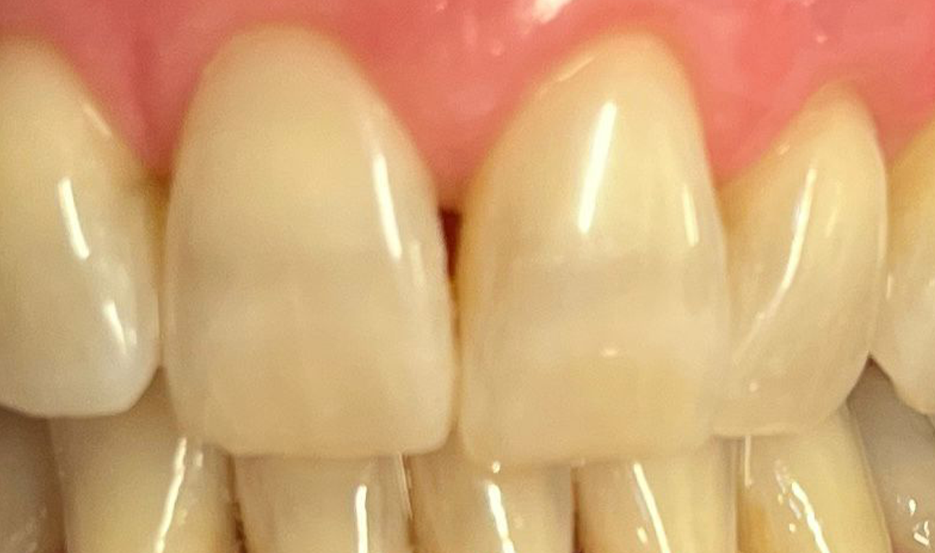 teeth-whitening-3-before (1) teeth-whitening-3-before (1)